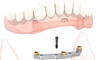 A digital image showing a titanium bar attaching all implants together before the final denture is placed on top