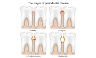 Diagram showing four different stages of gum disease