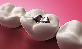 Animation of tooth with metal filling