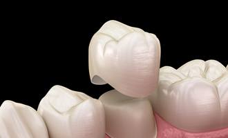 3D image of a crown being put on a tooth