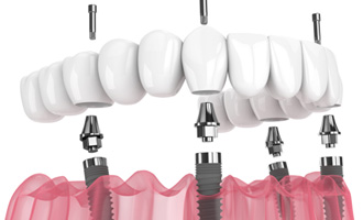 Digital image of All-on-4 dentures 