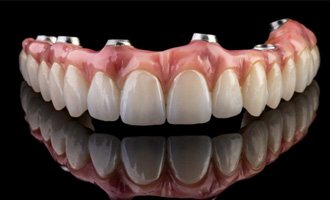 A set of implant dentures 