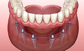 Implant dentures in Westminster