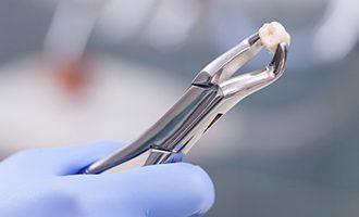 Metal clasp holding extracted tooth