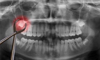 X-ray of wisdom tooth extraction