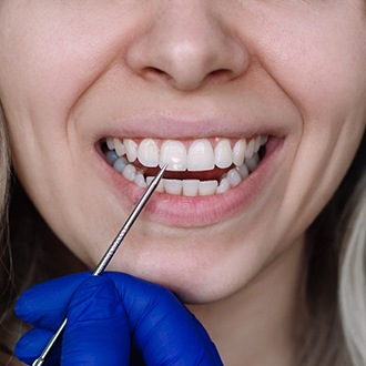 Dentist pointing to white spots on patient’s front tooth