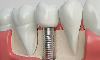 Model of dental implants after placement