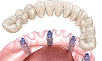 A digital image of an implant denture being placed over the top of four dental implants on the lower arch