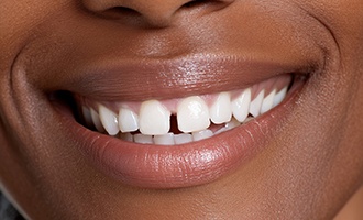 Up-close view of a gap between the upper front two teeth