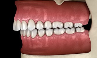 Digital view of an overbite