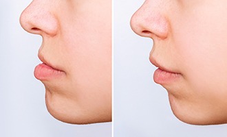 Before and after an underbite