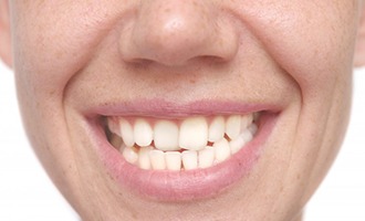 Person with a crossbite