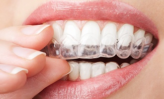 Patient placing Invisalign tray