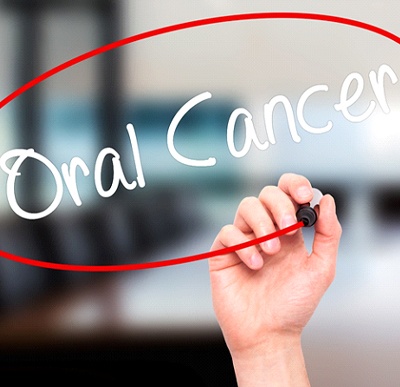 Oral cancer circled in red, oral cancer screenings in Westminster