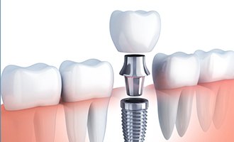 Animation of implant supported dental crown