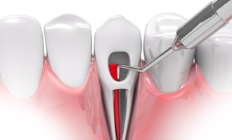 root canal illustration