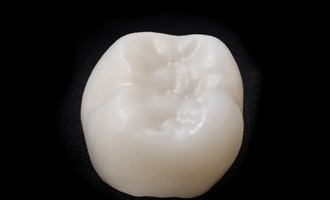 An up-close image of a natural, tooth-colored dental crown