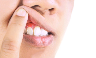 Person with red gums in Westminster