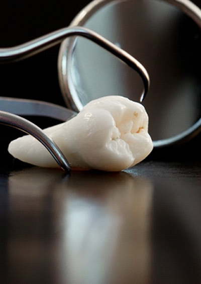 Extracted tooth