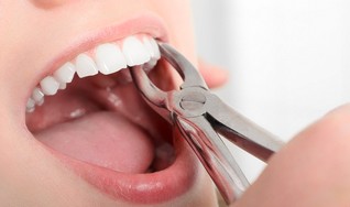 Tooth extraction