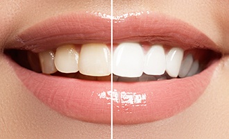 a before-and-after shot of a person’s smile with teeth whitening