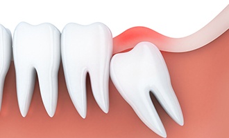 Animation of impacted wisdom tooth