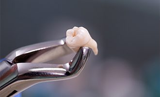 Clasp holding extracted tooth