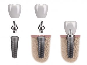 dental implant illustration