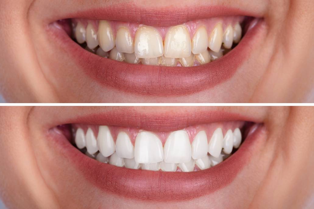 Does Over the Counter Teeth Whitening Work? Find Out Here