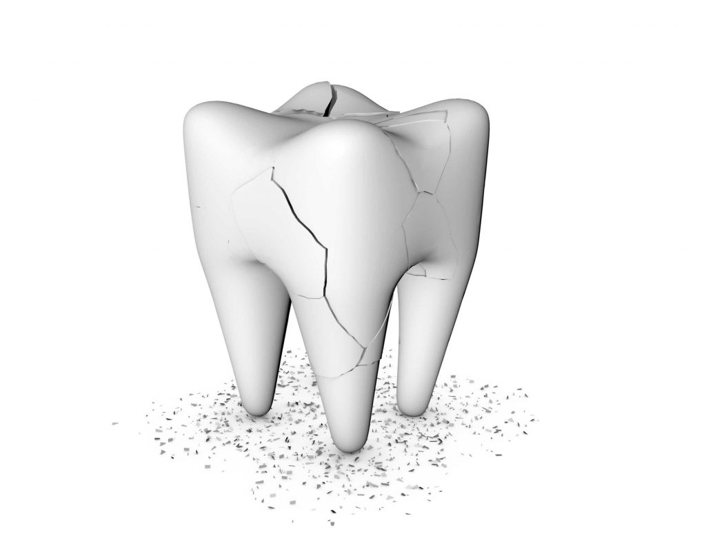 Digital image of a cracked tooth 