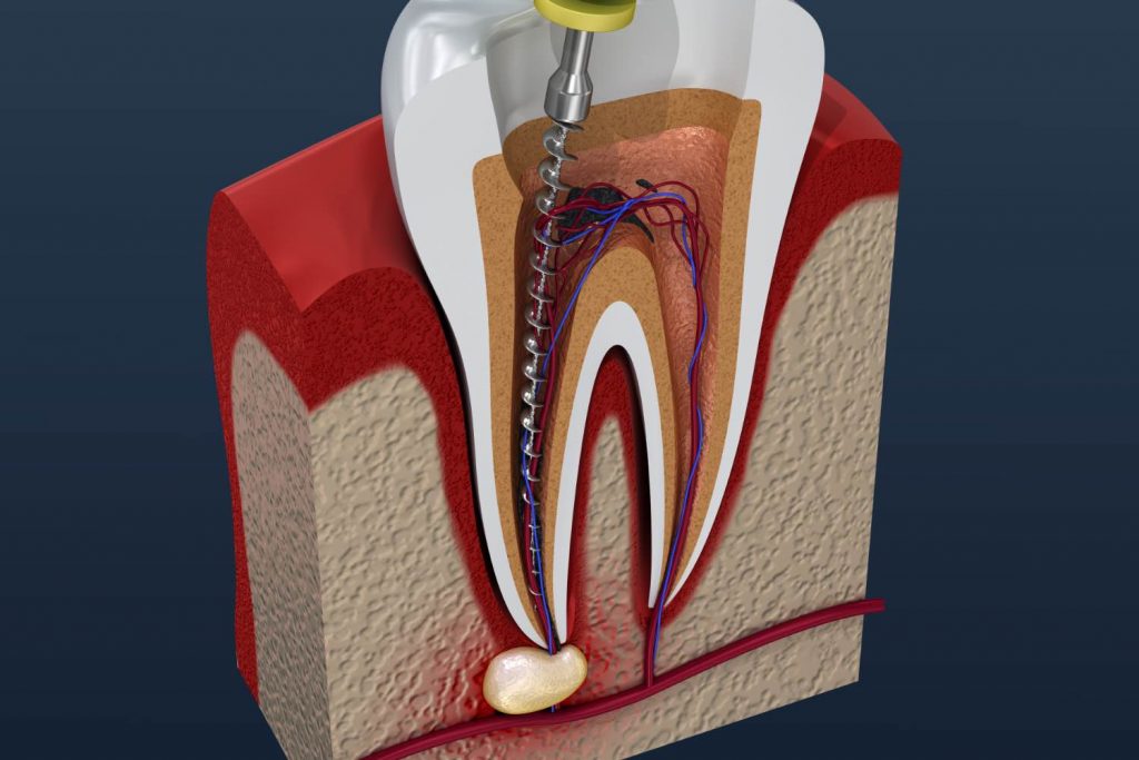 Illustration of a root canal
