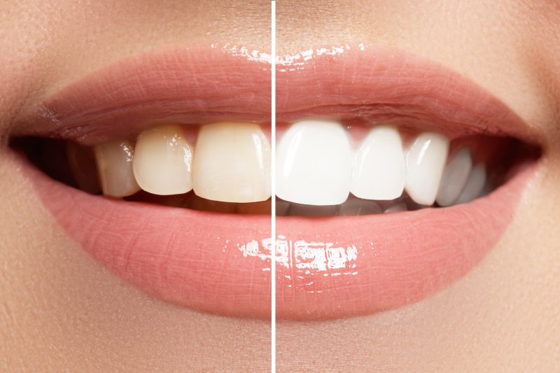 a before and after of a person who recently completed teeth whitening treatment