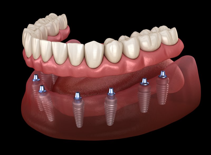 implant dentures