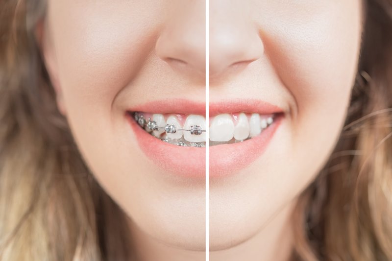 person with and without braces