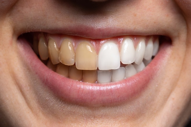 before and after image of stained and whiter teeth