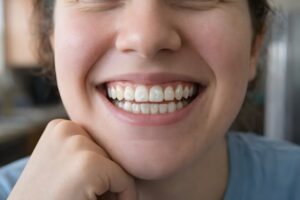 person with white spots after orthodontic treatment